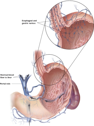 esophageal bleeding cirrhosis